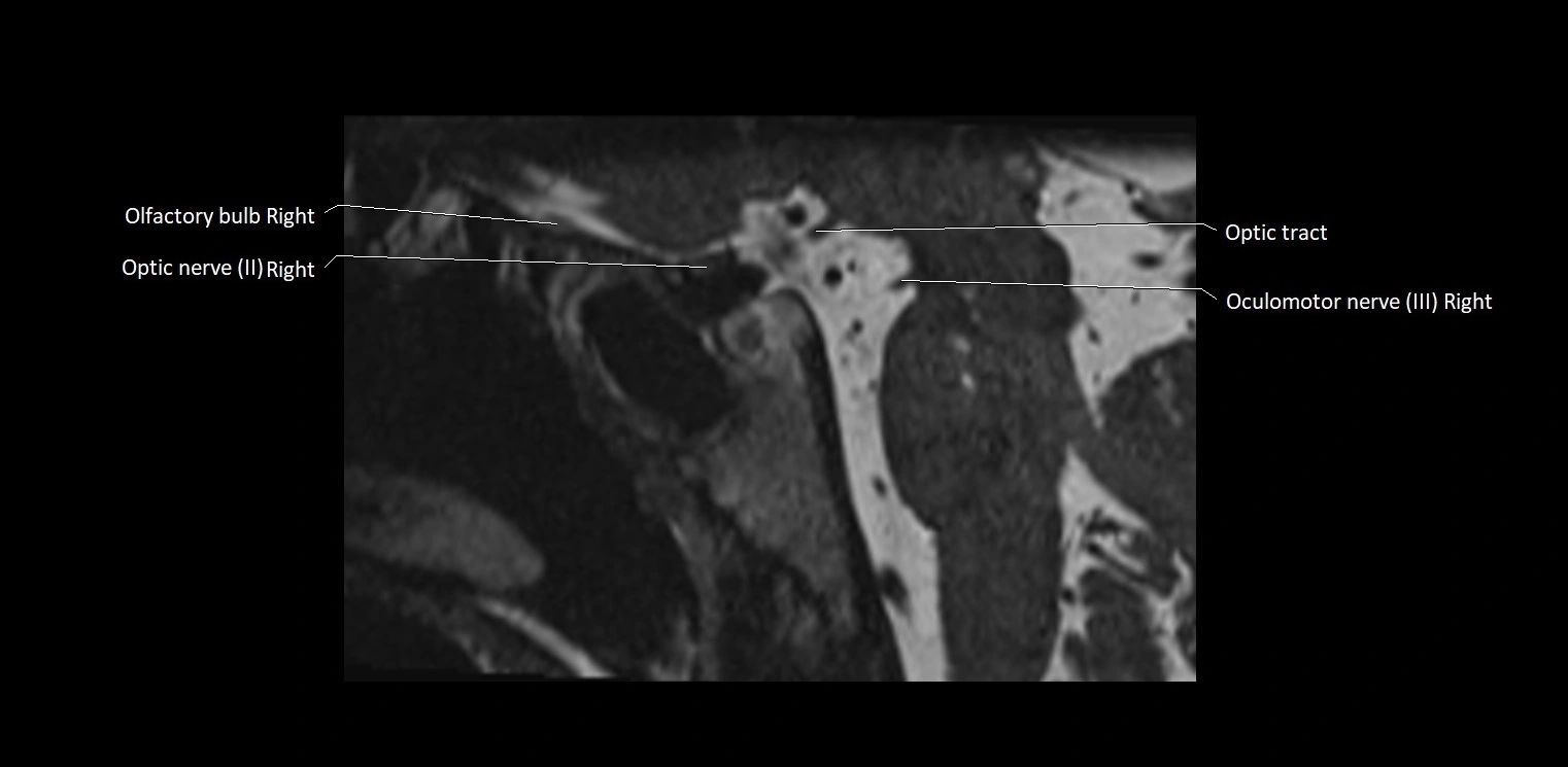 Cranial nerve sagittal anatomy MRI 3T image 36.webp